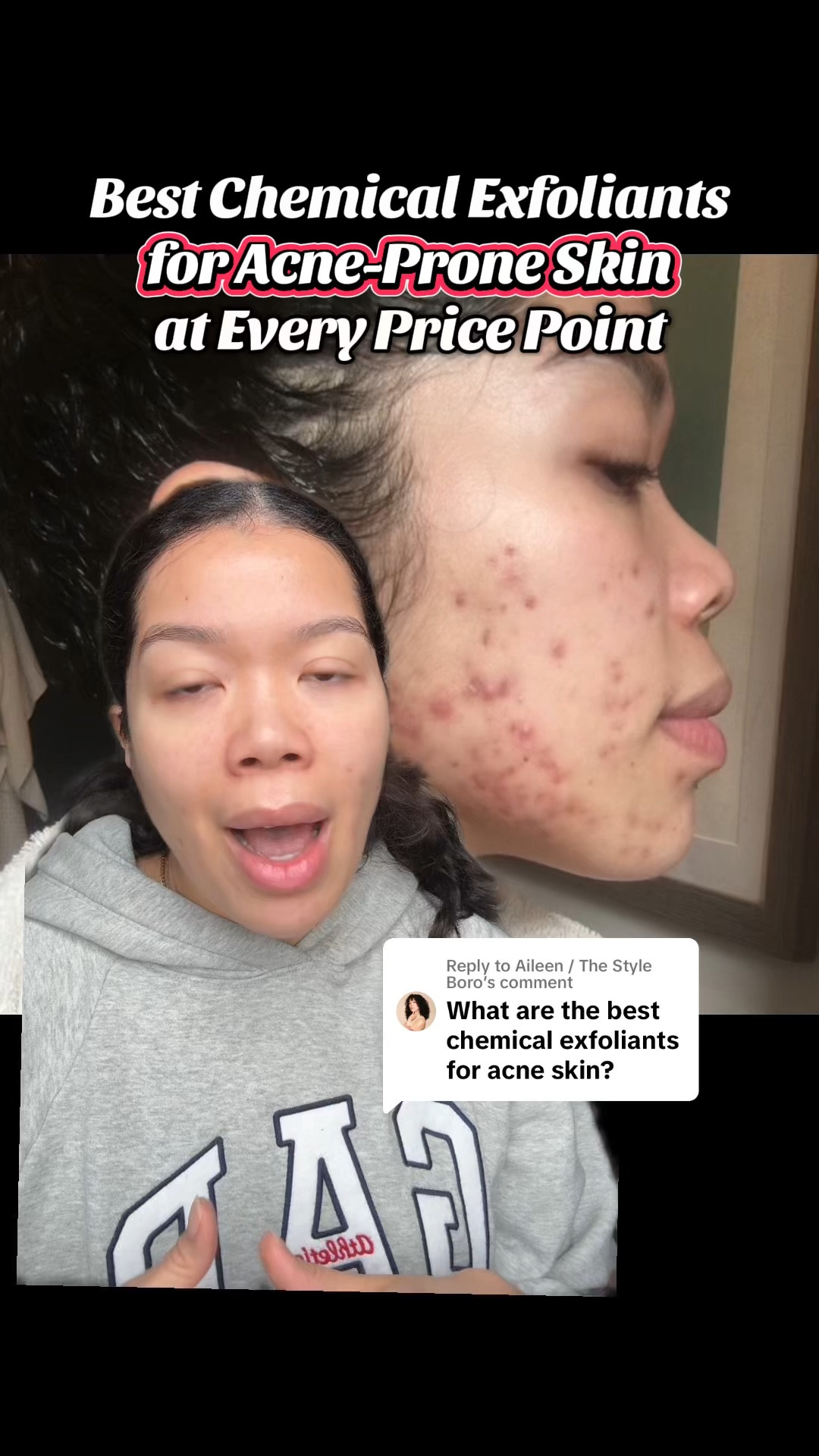 A good chemical exfoliants work wonders for acne-prone skin: slough off dead skin cells, prevent clogged pores, reduce inflammation.

They also help post-breakouts by fading acne marks.
These are my low-to-high picks from The Ordinary, Paula's Choice, and Dr. Dennis Gross Skincare.

#greenscreen #acnecommunity #skincarecommunity
#acnechemicalexfoilants #acnetreatment

#LTKFindsUnder100 #LTKBeauty