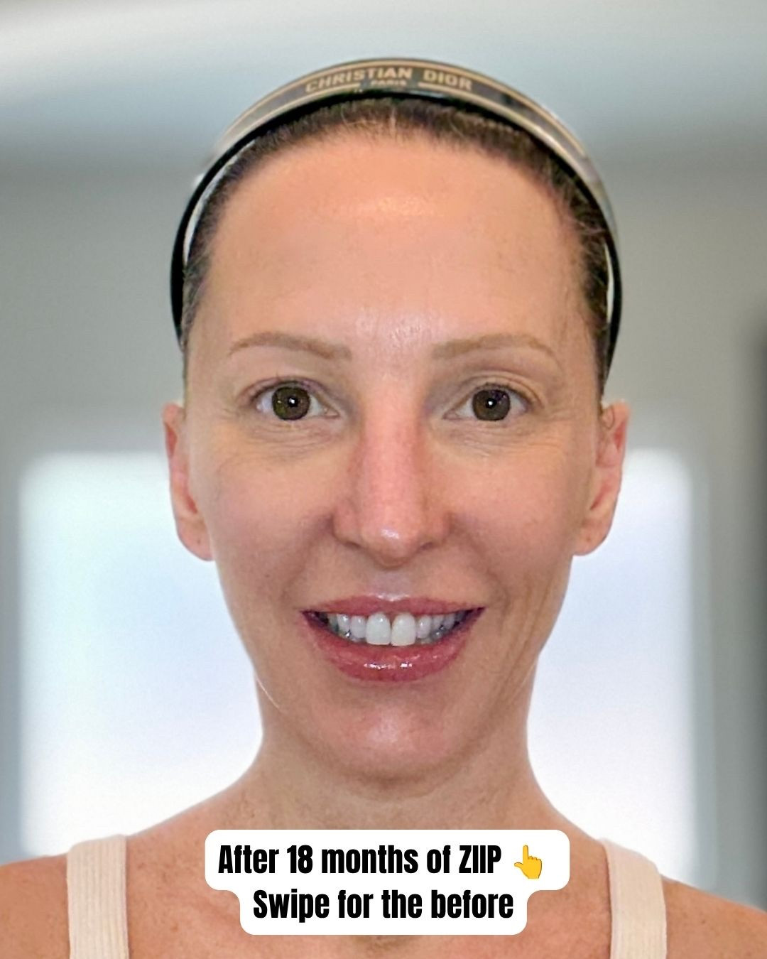18 months of ZIIP Halo microcurrent. This is what consistent at-home treatment actually looks like. No botox, no filler (besides my lips), no clinic visits. 4-5 sessions most weeks since January 2024.

Microcurrent works by toning and lifting facial muscles while stimulating collagen at a cellular level. The results are cumulative which means they build the more consistently you use it.

I have one-on-one training with ZIIP founder Melanie Simon herself so I know exactly which treatments to use and when. The gel is non-negotiable every single time.

Comment ZIIP below and I'll DM you my discount code and full review link 💡

#ZIIPHalo #MicrocurrentFacial #NoBotox #FaceLift #AntiAging