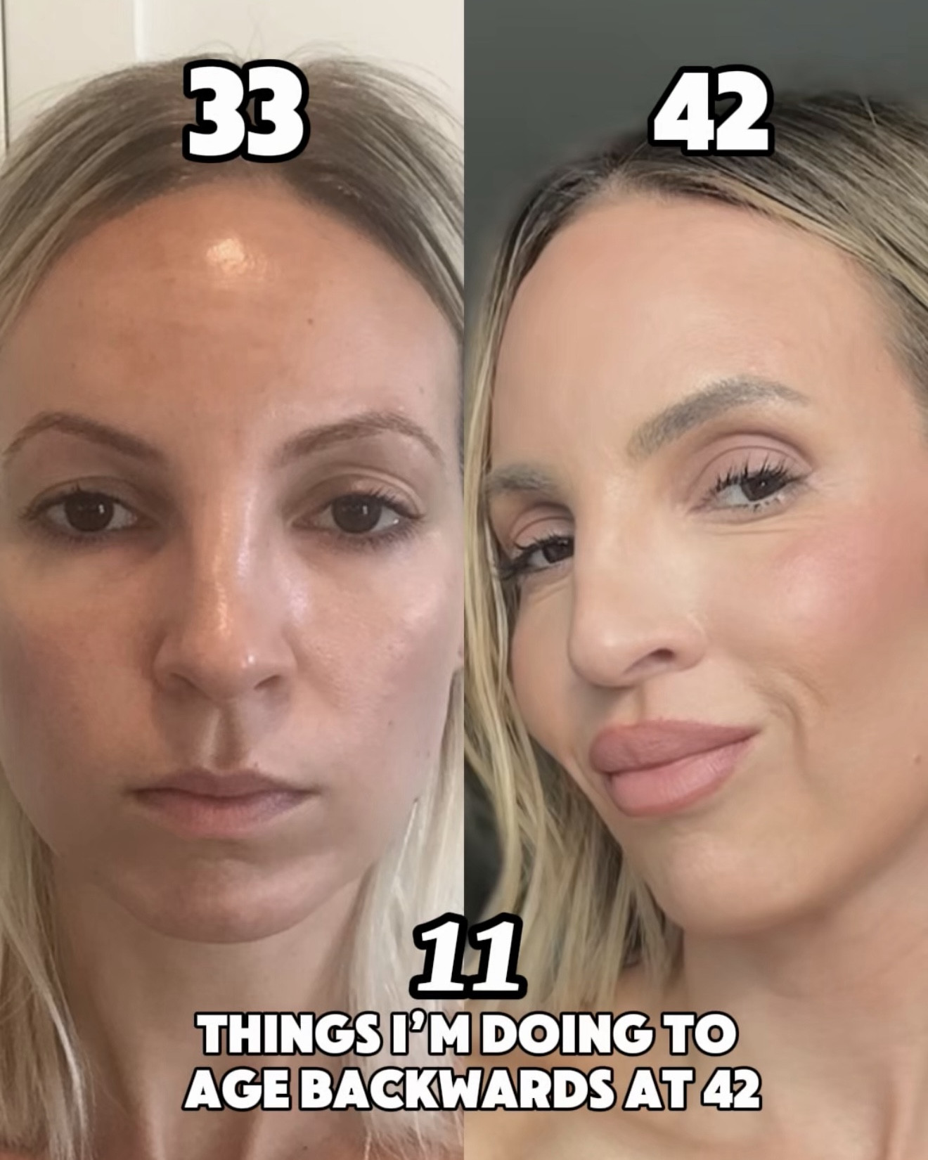 Here’s the full breakdown of the 11 things that changed my face — with the exact products and treatments I use:
1. Lip lift — a subtle structural change that shortened my philtrum and softened my lower face. Made me look more feminine ￼
2. Skin flooding — layering hydrating toners + essences to deeply support my barrier instead of constantly exfoliating.
3. Hormone optimization — I worked with my doctor to support what was naturally declining. This made a bigger difference than any topical ever could.
4. Tretinoin — long-term collagen support. I always buffer it with the barrier cream linked here so I don’t wreck my skin.
5. Barrier repair — fewer actives at once, more intentional recovery.
6. Microneedling — consistent collagen stimulation over time. I use the Dr. Pen M8 7. Lasers 1–2x/year — resurfacing and pigment correction for maintenance, not panic.
8. Melasma — this is important.
The cream that completely changed it for me is Obagi Nu-Derm Blender #5. It requires a prescription, and you have to cycle it properly under a doctor’s supervision. It’s not something to use casually or long term without guidance.
I can’t link it here, but I’m linking a non-prescription option that contains arbutin, which is a gentler pigment-support ingredient.
9. LED therapy — consistent at-home red light for collagen support.
10. Injectables — I shifted away from chasing volume and focused more on collagen-stimulating treatments. And yes, continued use of Botox/dysport
11. Actives I don’t rotate weekly — vitamin C, growth factors, and copper peptides for daily collagen support.

Linked all my favorite products here ￼

#LTKBeauty #LTKstorytime #LTKOver40