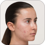 Nutrafol Skin Acne Supplement for Women | Nutrafol