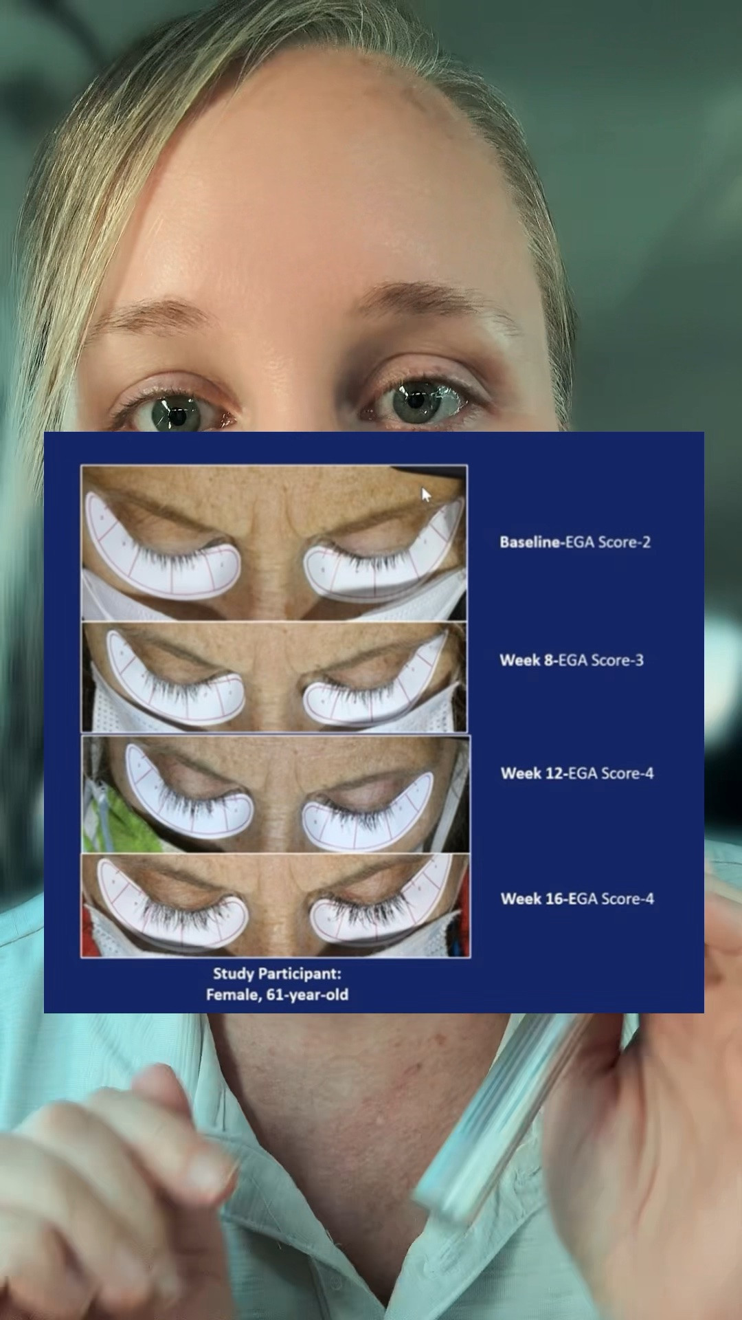I’ve only been using this for 2 weeks… but LOOK at these 16 week results 👀✨

The before & after from a 61-year-old using this lash serum is honestly amazing and has me SO excited to keep using it

Fuller, longer-looking lashes without extensions 🤍

#LTKselfcare #LTKOver40 #LTKBeauty