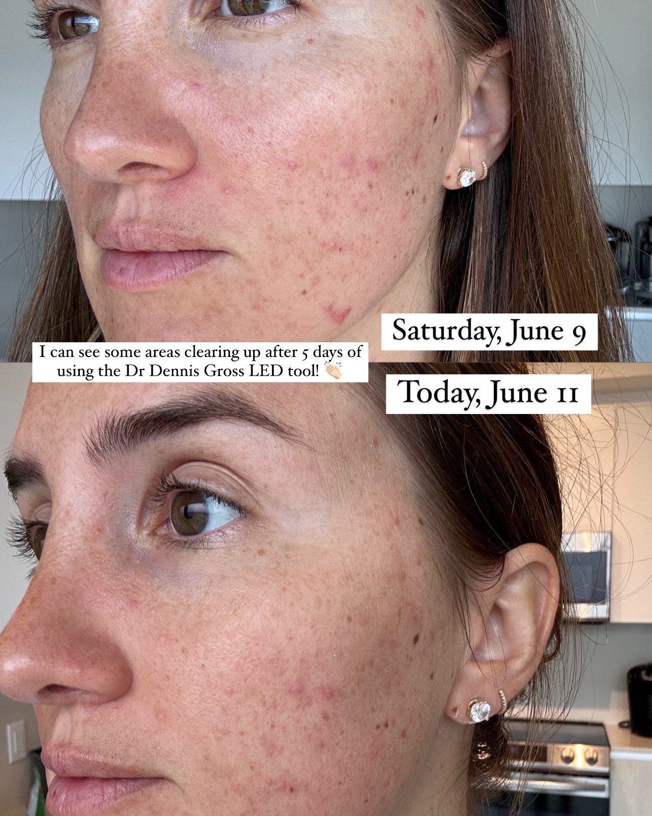 Acne progress! I am on day 5 of using the Dr Dennis Gross mask once a day!  Progress photos from the past weekend.

If you’re interested in using the mask, make sure to do your own research and talk to your doctor! I’m glad I did mine and can see the results happening!

Use code WELCOME15 for 15% off at Dermstore (works for first time customers!!)

#LTKBeauty #LTKxNSale