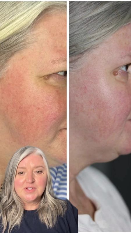 Look how the @omniluxed Contour at-home Red light therapy device has improved my overall redness and rough skin. It’s well worth the investment! 

#rosaceahelp #matureskincare #redlighttherapybeforeandafter #realredlighttherapyresults 

#LTKbeauty