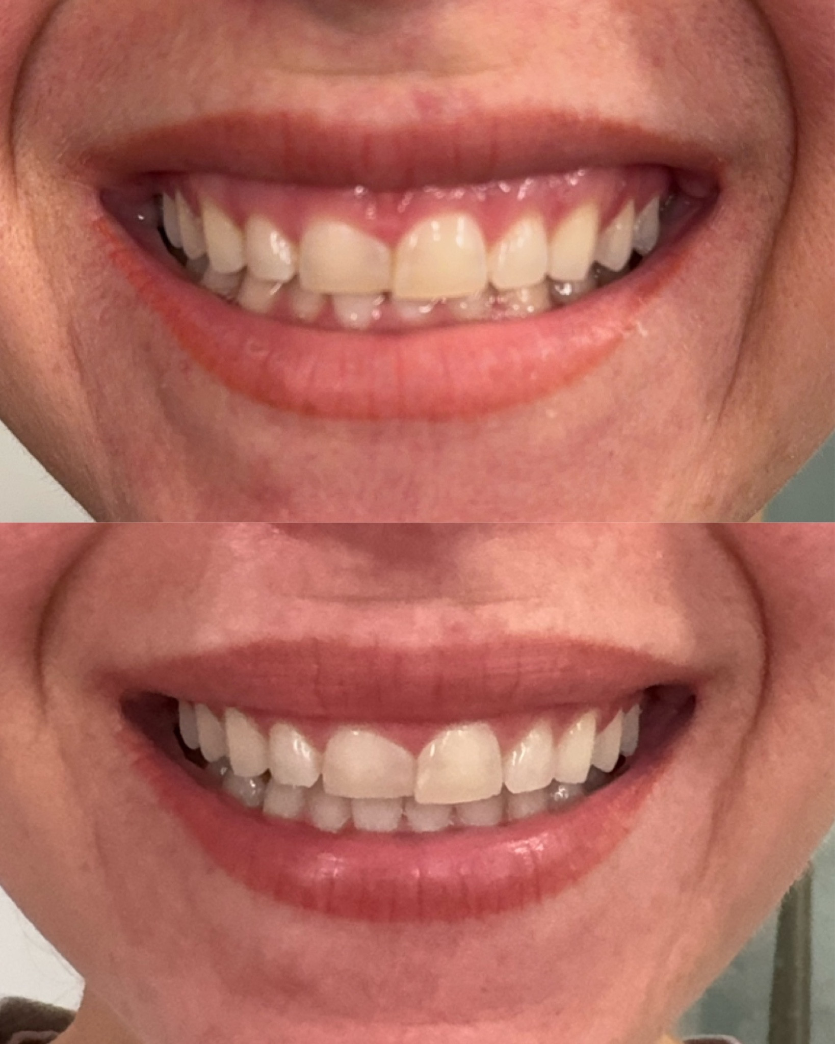 inpro teeth whitening! linking from Amazon below for white shiny teeth 

#LTKbeauty #LTKstyletip #LTKfindsunder50