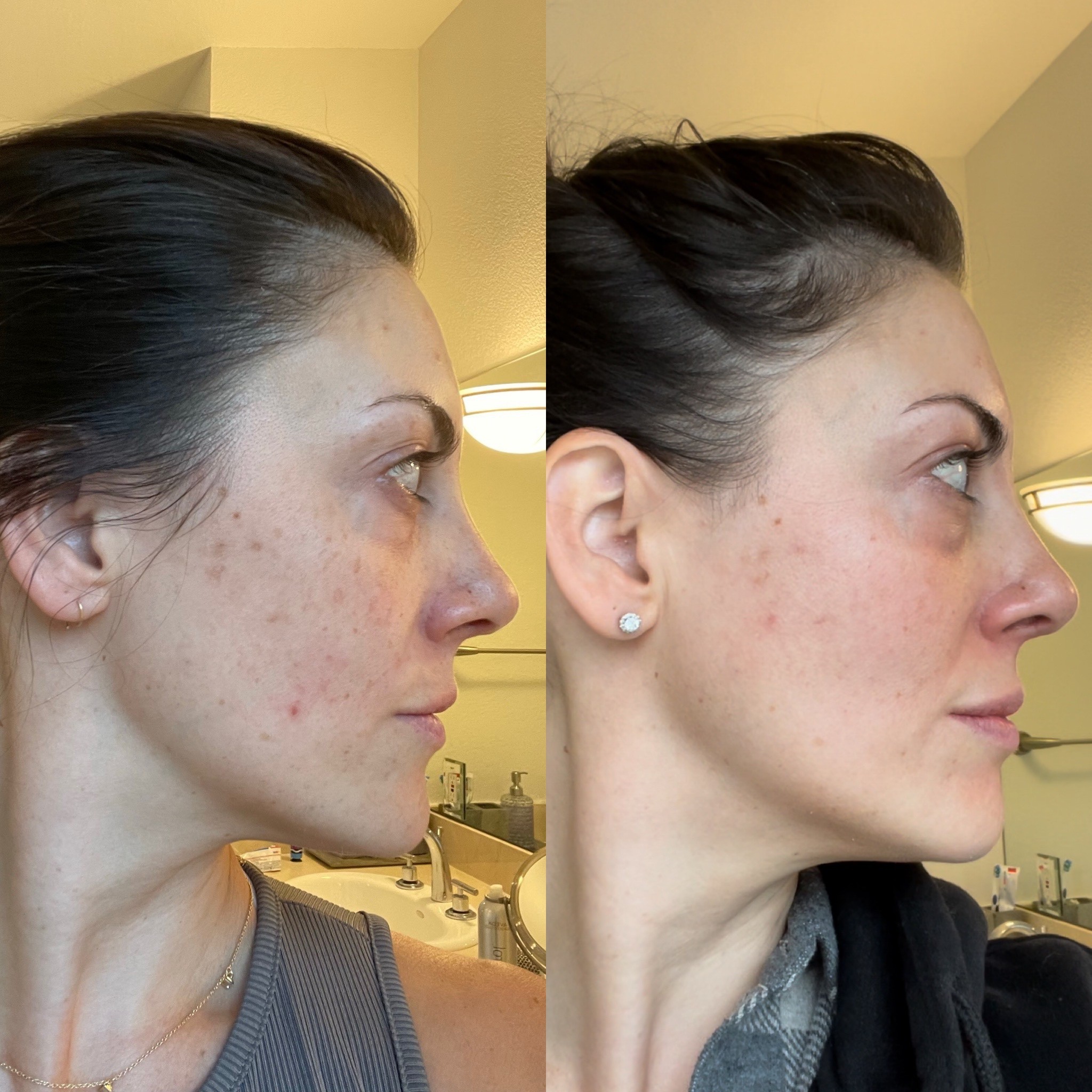 Every wonder if those online skin treatments work? Here is my 3 week skin glow up after using musely’s spot cream! 
Hyperpigmentation be gone! #musely #skincare 

#LTKbeauty #LTKunder100