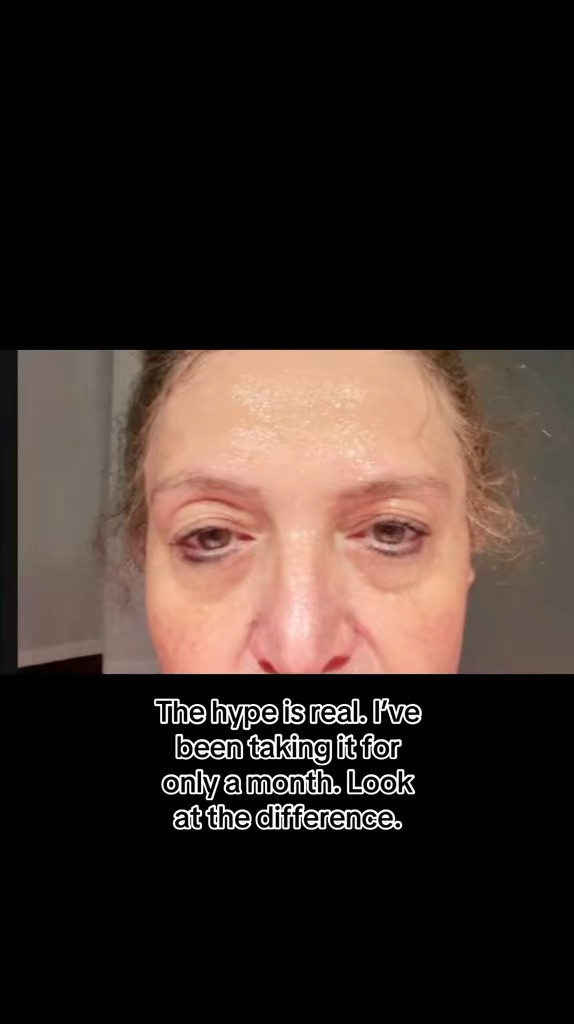 These results speak for themselves .I started taking NAD supplements because of all the great reviews. I’m so glad I tried it . This is my skin after 1 month. It also has reservratrol . This has made my skin feel and look firmer . 

#LTKBeauty #LTKOver40 #LTKWatchNow