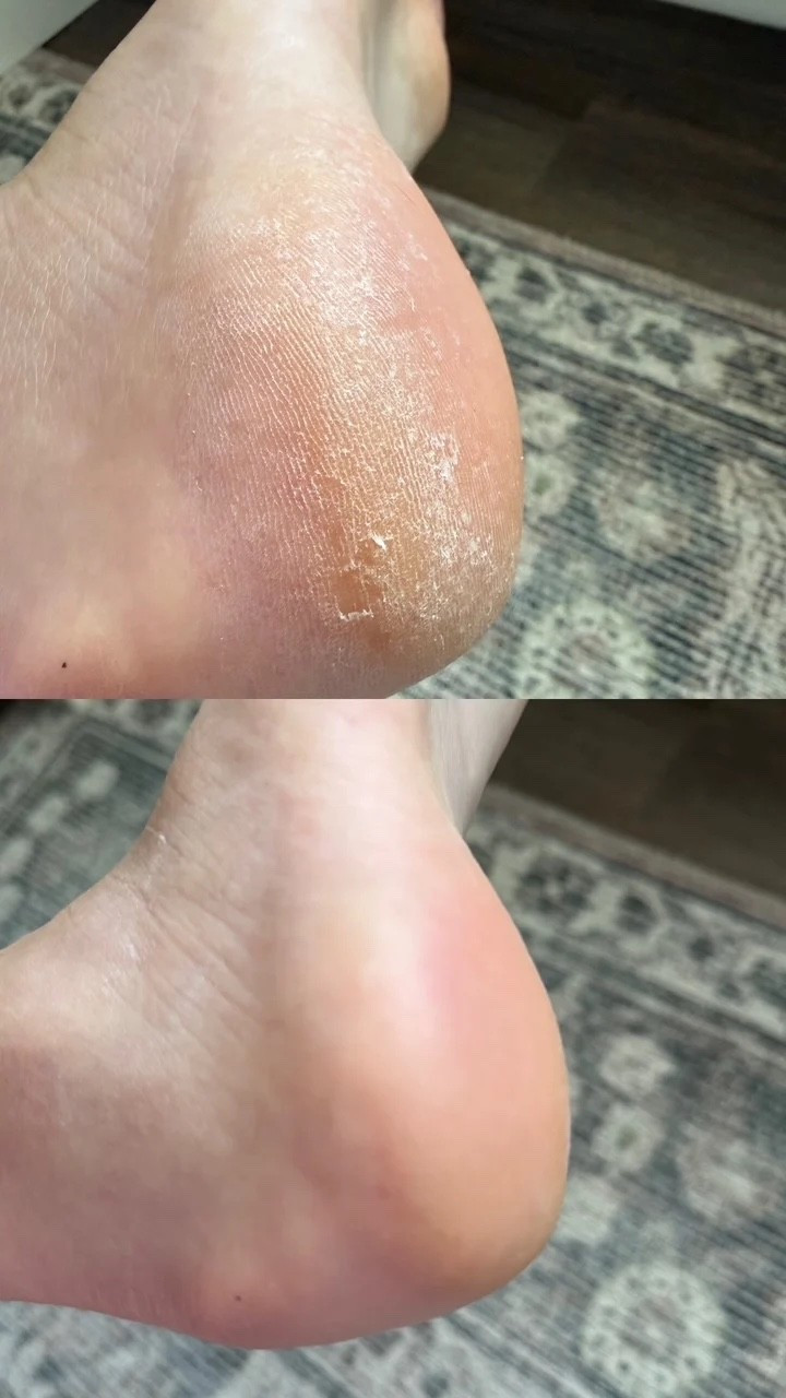 I’ve been using This electric callous remover and can I just say I am SHOOKETH?! Apologies for the heel pic, but I just HAD to share this! I grabbed this thing on Prime Day because I'd seen rave reviews - I'd tried various "removers" of dead skin before, from other electric options to the grater (IYKYK) to the chemical peels, and I get salon pedicures regularly enough that you'd think (read: hope) dead skin wouldn't be a problem - but, alas. I'm running around barefoot a lot, and here we are.

This before/after is from THIS MORNING. Zero editing or filter - and the "after" looks fake because my skin hasn't been this baby soft in literal DECADES. (I just rinsed off + applied lotion before snapping the shot!).

INCREDIBLE. FIVE STARS. 12/10 RATING!

#LTKselfcare #LTKBeauty