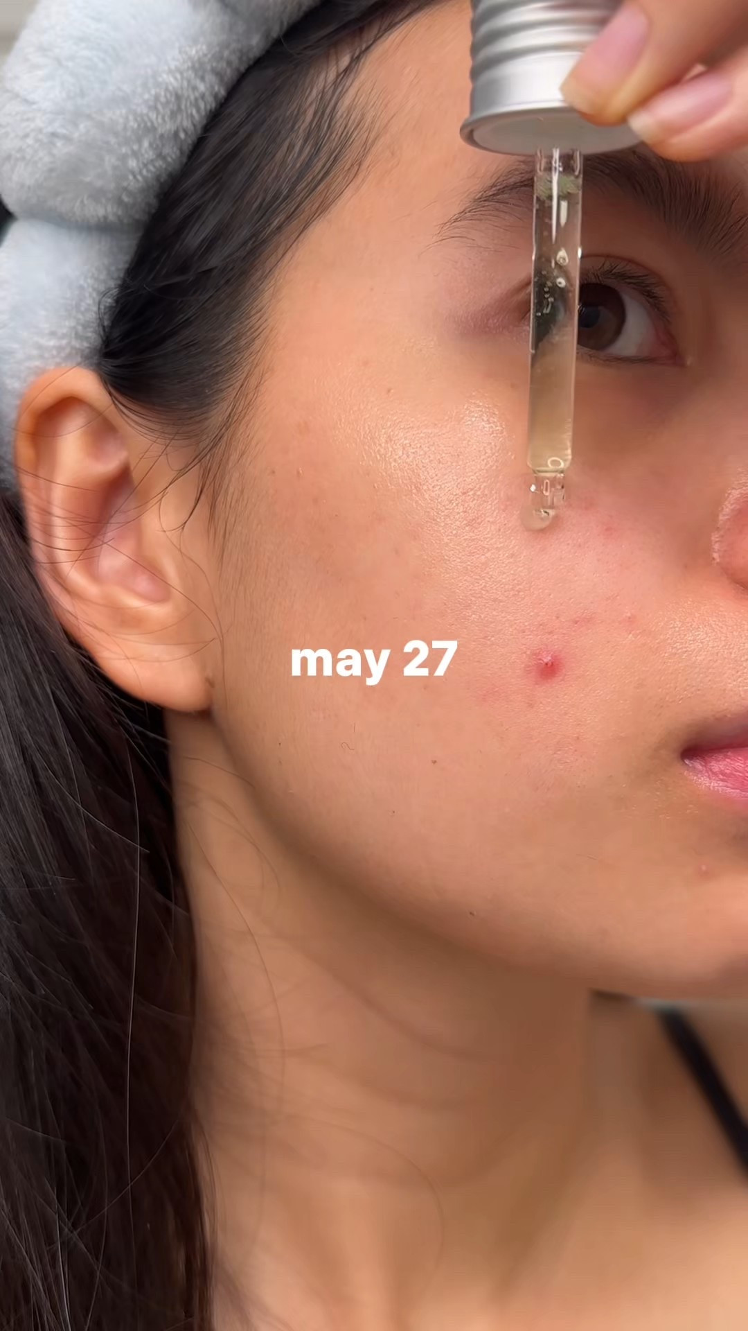 Azelaic acid is the IT girl for acne! 💝

#LTKBeauty #LTKselfcare