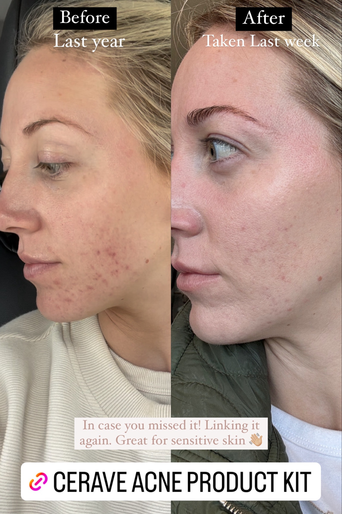 Finally, skincare that delivers real results! My journey with Cervae has transformed my skin—no more guessing, just visible improvement. This affordable Amazon kit is my go-to for a reason—it works!

#LTKBeauty #LTKFindsUnder100 #LTKStyleTip