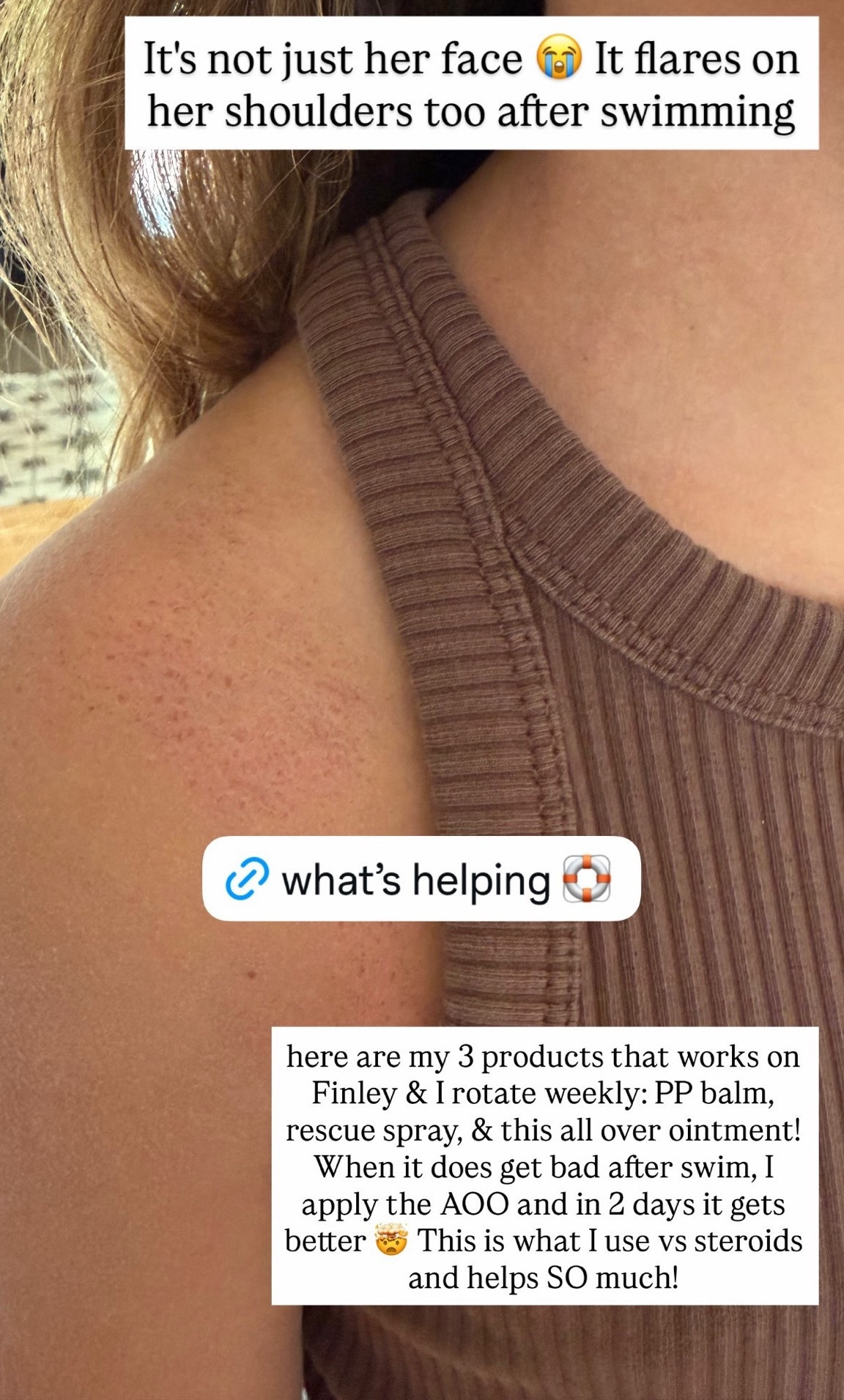 for eczema/chlorine sensitive skin here are 3 products working for us. I rotate weekly: PP balm, rescue spray, & this all over ointment! When it does get bad after swim, I apply the AOO and in 2 days its MUCH better

#LTKKids #LTKmomlife #LTKSaleAlert