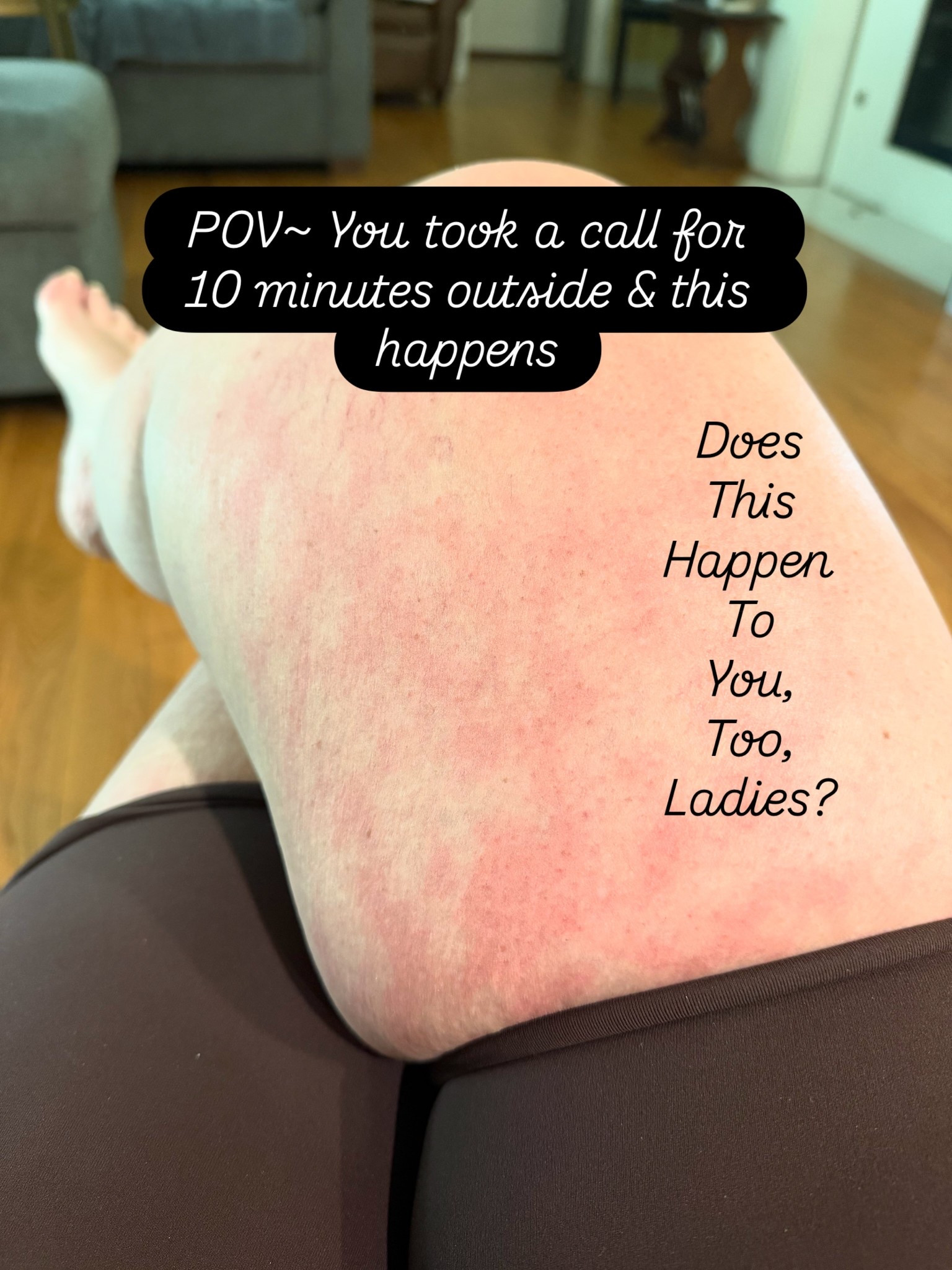 Do your legs get a net like, mottled, blotchy look after a few minutes in the sun, ladies?

Comment YES or NO so we can talk more about it⬇️

#womenshealthmatters #healthadvocate #womensissues #lipedema #womensupportingwomen❤️
