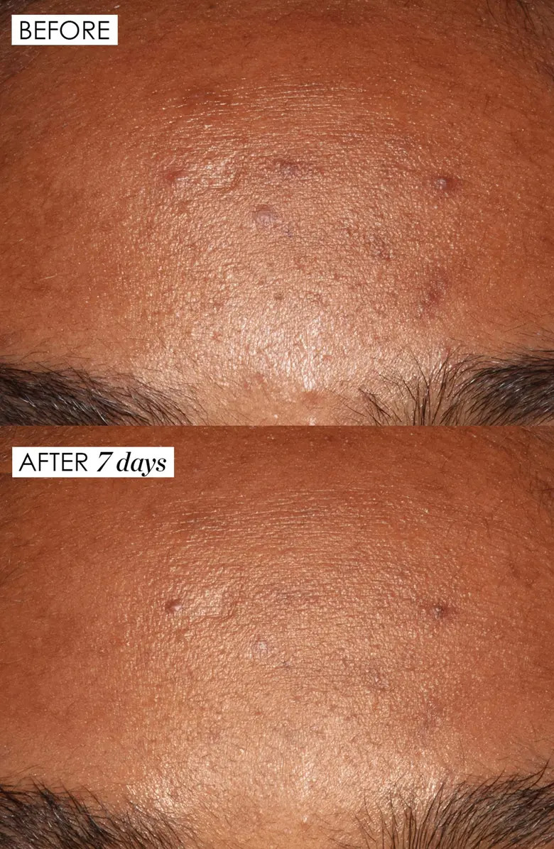 Jumbo Good Genes All-in-One Lactic Acid Exfoliating Face Treatment $284 Value | Nordstrom