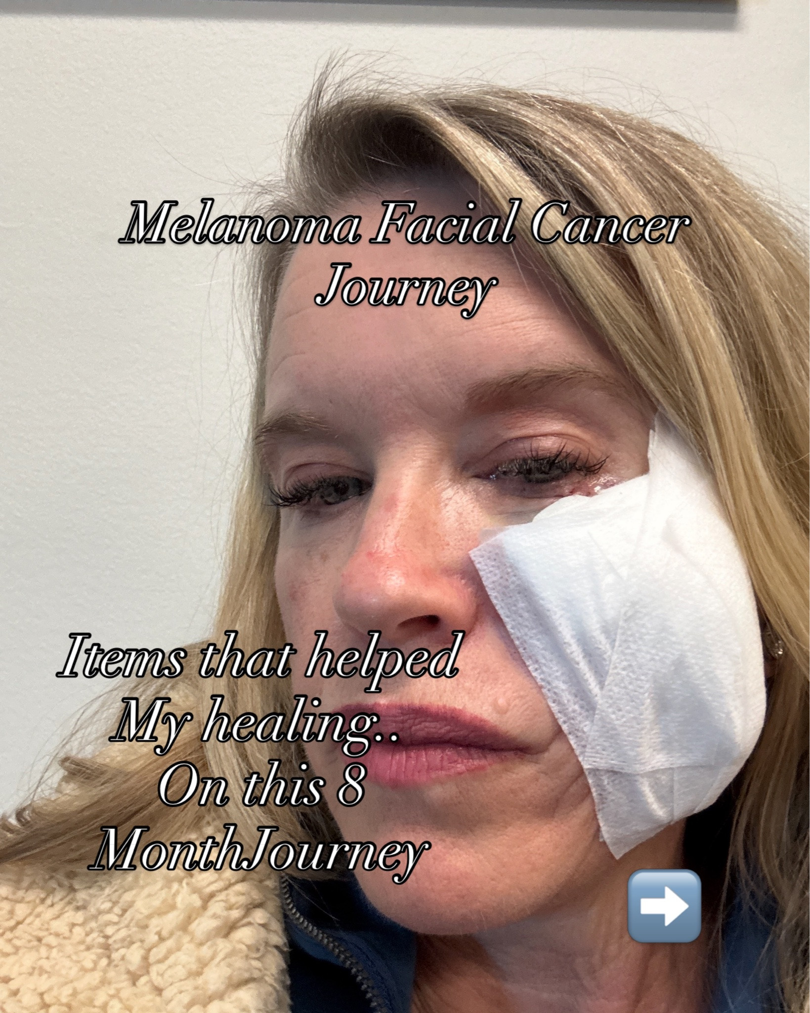 Melanoma Facial Cancer
—Journey—-

Items that helped my healing on this 8 month Journey.

For more info on this Journey, I have 8 parts in feed and in highlights. 

Please note I am not a doctor and these are just items and products I have researched and have helped me on my journey.

My hope is that it will help others going through melanoma or facial scars as well as bring more awareness to go get your skin checked!

Thank you for your support, on this journey and for using my links if there is products your interested in.

Comment “shop” for links ⬇️

Thank you for following along and liking this post and sharing with your friends.

If you have any questions comment below or dm me.
thank you, D’Arcy

Midlife / melanoma cancer/ skin cancer/ over 50 / utah living