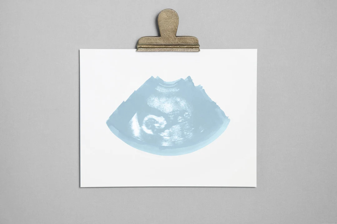 FROST Ultrasound, Sonogram, Physical Print - Etsy | Etsy (US)
