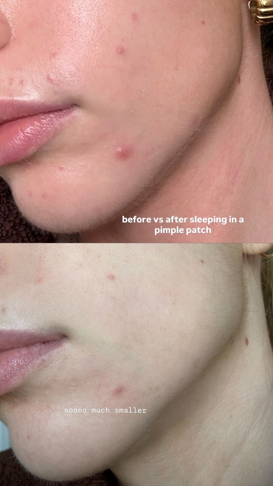 The best pimple patches ever !!! 

#LTKbeauty #LTKaustralia